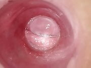 Playing with clear plug cervix view