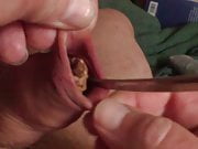 A spoon and a pine cone in foreskin - 3 minutes 